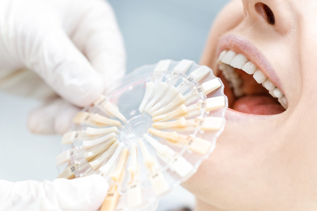 Dentist using a shade guide to match teeth color, addressing 'Is teeth whitening safe at Brinkley Dental Group.