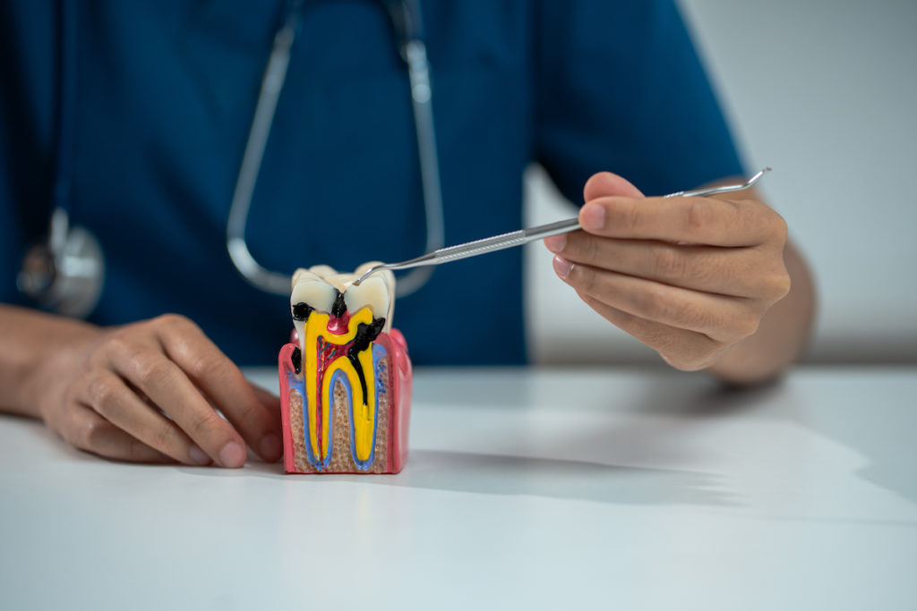 Dentist holding a tooth model showing a root canal procedure, close-up.