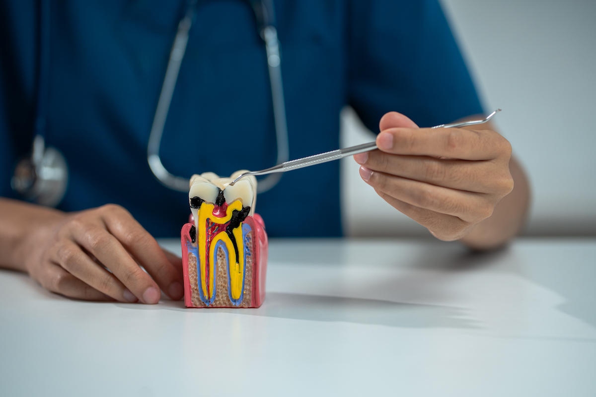 Dentist holding a tooth model showing a root canal procedure, close-up.