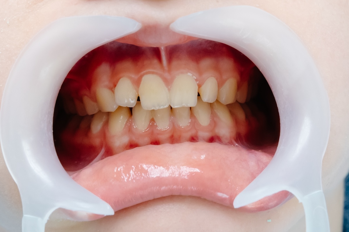 Close-up of teeth and gums during a dental exam, showing the impact of lifestyle and gum health.