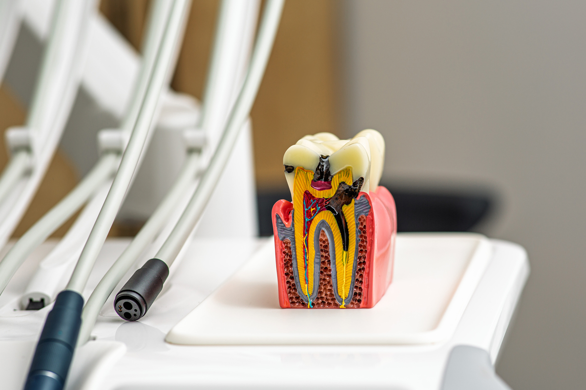 The Cost of Delaying a Root Canal