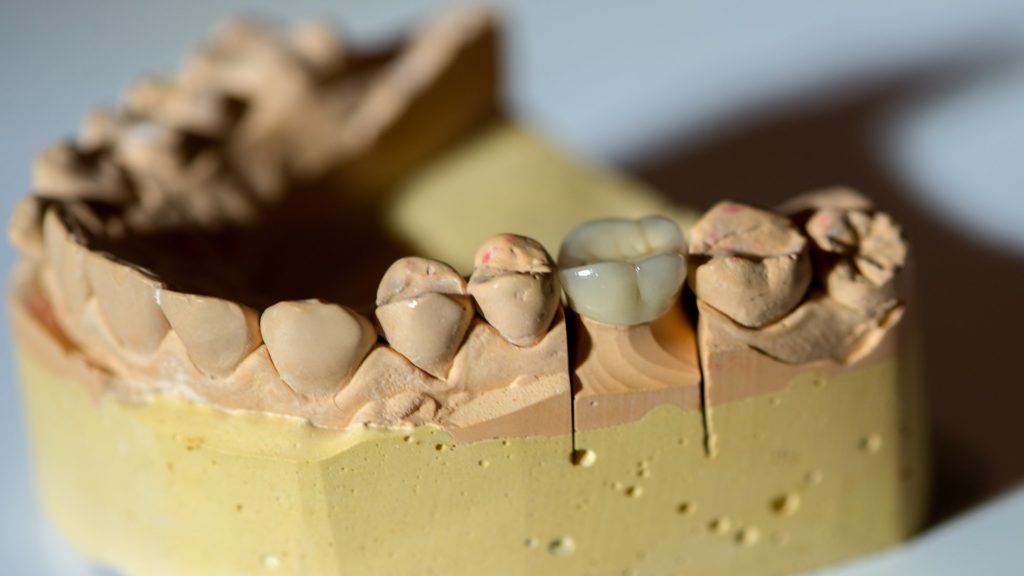Signs Your Dental Crown Needs Replacement